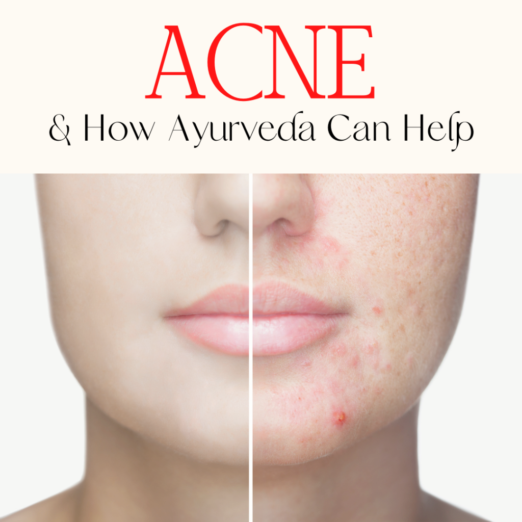 acne and Ayurveda